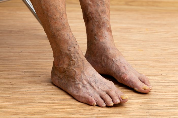 It’s Not Just NBA Stars — this Serious Condition Hits Black Americans at Far Higher Rates